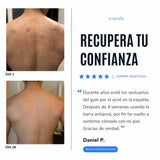 Barra Antiacné™